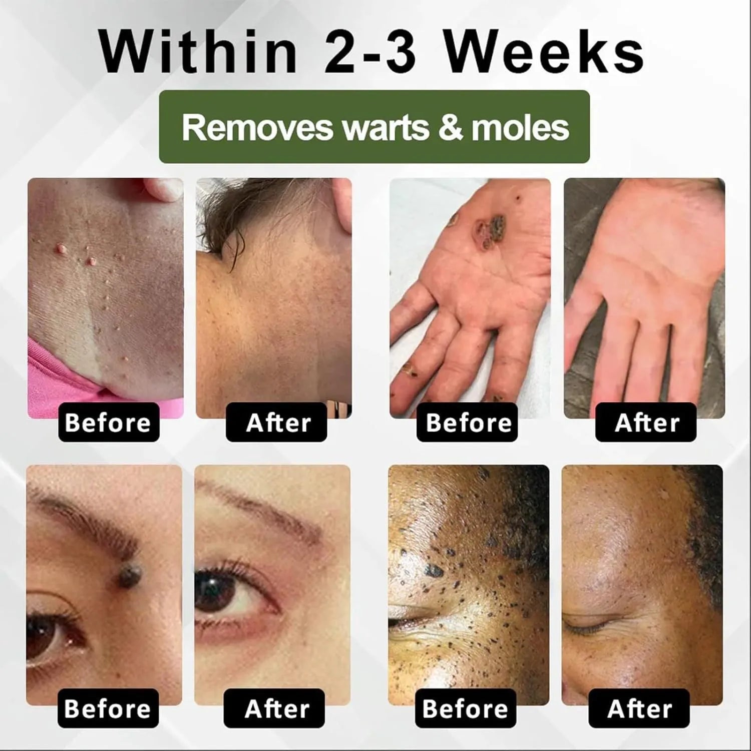 Natureerase 45g mole spot removal gel with hydrating formula and applicator