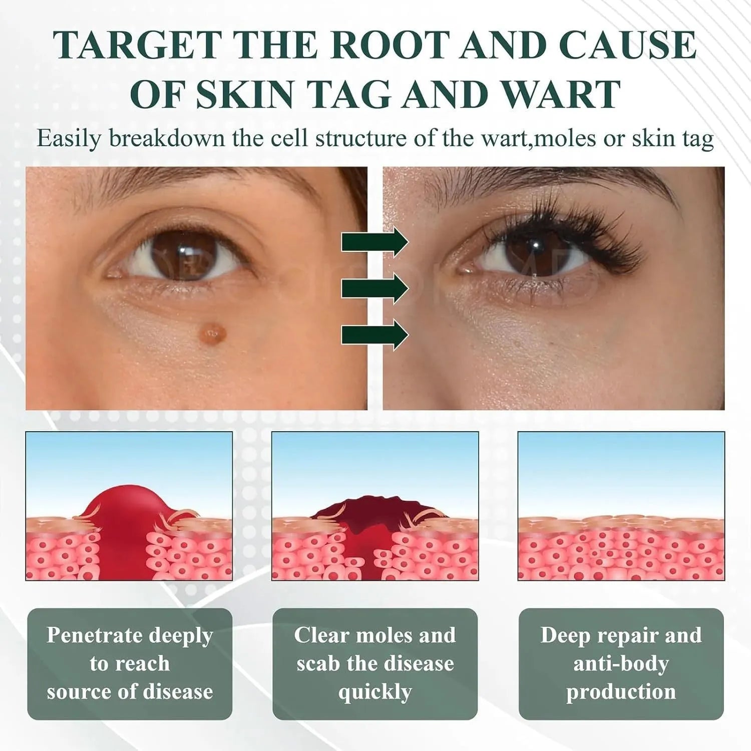 Natureerase 45g mole spot removal gel with hydrating formula and applicator