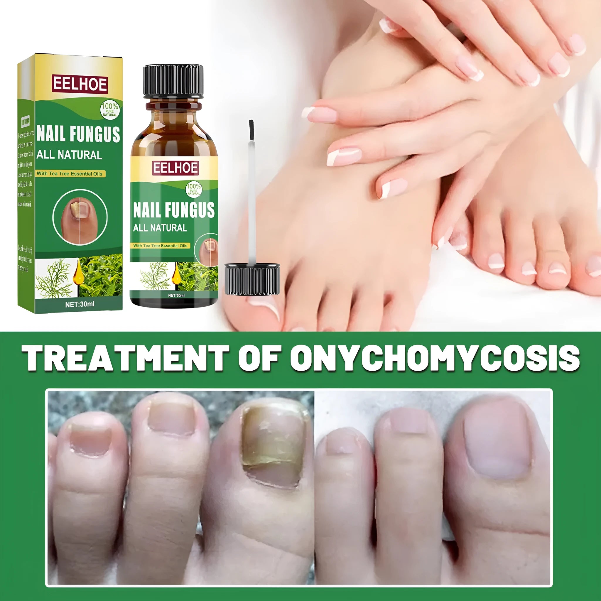 30ml bottle of tea tree oil nail repair solution for hand and foot care with thick nourishing formula